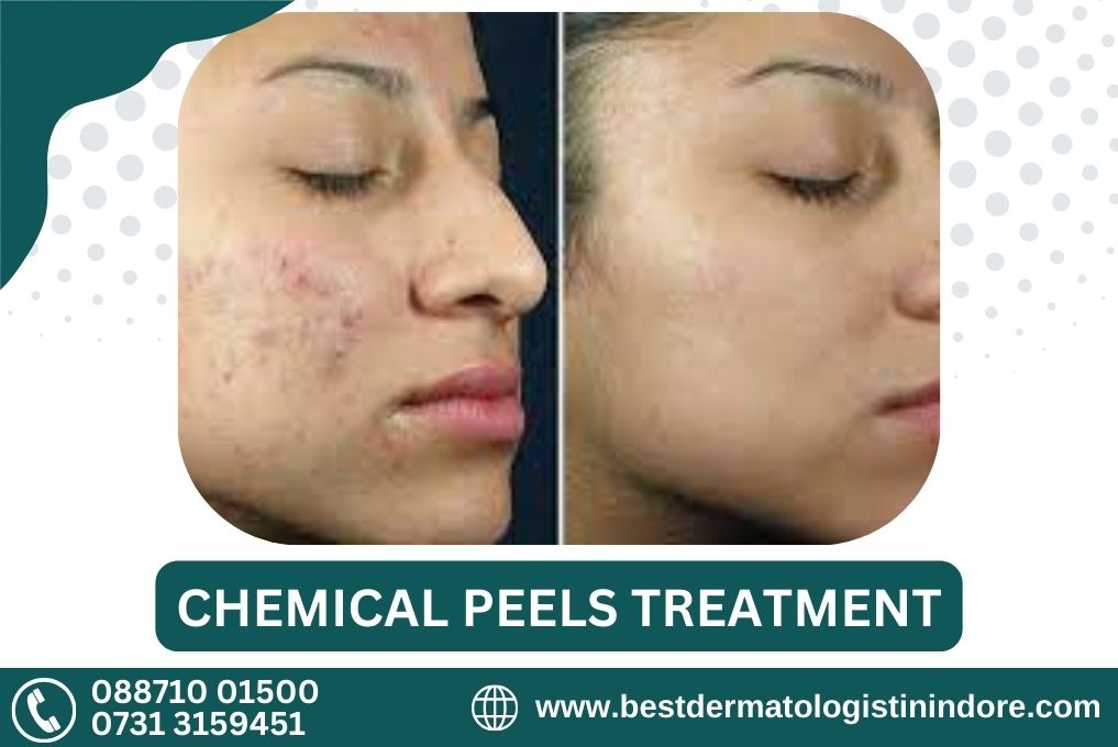 Famous Doctor for Chemical Peel in Indore